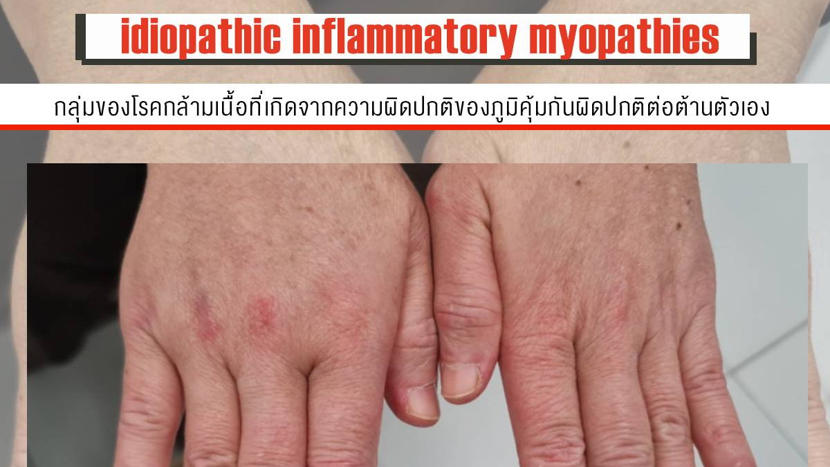 โรงพยาบาลราชวิถี เผย idiopathic inflammatory myopathies (IIMs)  กลุ่มของโรคกล้าม...