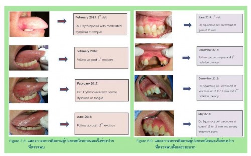 รพ.เชียงรายฯ ใช้แอพพลิเคชั่นช่วยคัดกรองค้นหารอยโรคมะเร็งช่องปากระยะแรก