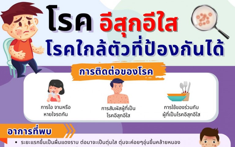 โรคอีสุกอีใส โรคใกล้ตัวที่ป้องกันได้