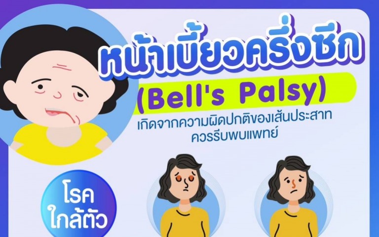 หน้าเบี้ยวครึ่งซีก (Bell's Palsy ) โรคใกล้ตัว เกิดจากความผิดปกติของเส้นประสาท ควรรีบพบแพทย์