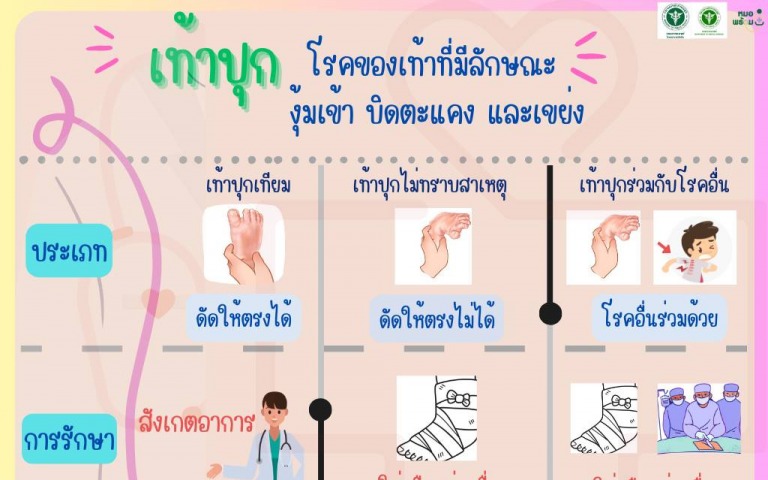 โรงพยาบาลเลิดสิน กรมการแพทย์ แจงประเภทเท้าปุก ควรมาพบแพทย์เร็วที่สุด