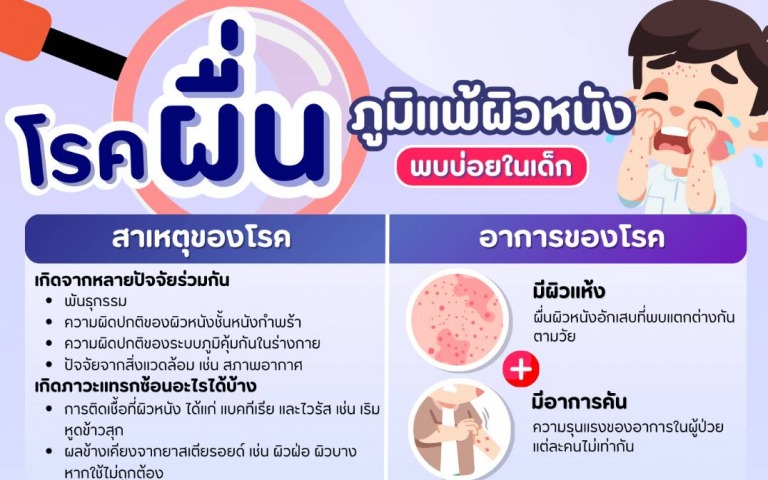 โรคผื่นภูมิแพ้ผิวหนังอักเสบ