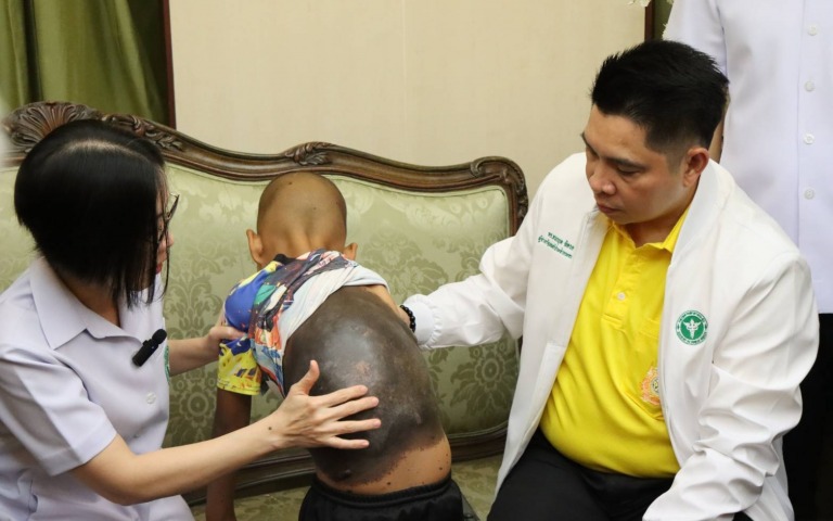 สธ.มอบกรมการแพทย์รักษาผู้ป่วยเด็กโรคปานยักษ์แต่กำเนิด (Congenital Giant Melanocy...