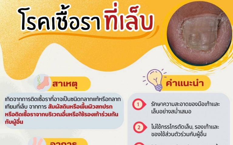 อันตรายจากโรคเชื้อราที่เล็บ